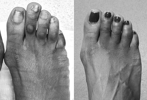 Footwear, Exercise and a Healthy Lifestyle can Prevent Corn Foot