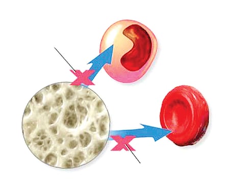 Debunking the Myths about Aplastic Anemia 