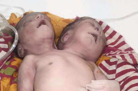 Woman Delivers Baby Girl with Two Heads in Bhubaneswar
