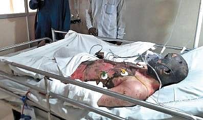 A victim undergoing  treatment at a local hospital in Srikakulam district before being shifted to Seven Hills Hospital in Visakhapatnam on Monday | express