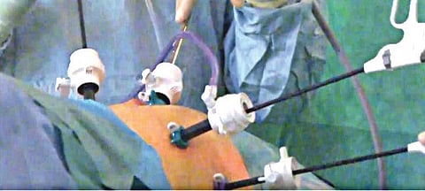 Cure Diabetes With Keyhole Surgery