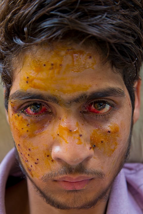 Mohammad Imran Parray, who got wounded after being hit by pellets during a protest recovers at a hospital in Srinagar, Indian controlled Kashmir, Wednesday, July 13, 2016 | AP