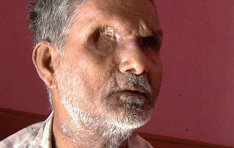 Patel Shah, 60 The Bhagalpur resident was blinded in October 1980 allegedly by the police. Shah had later alleged that then SP V D Ram was present when a mob and policemen punctured his eyes with a bicycle spoke and injected acid into his eyes. | EPS
