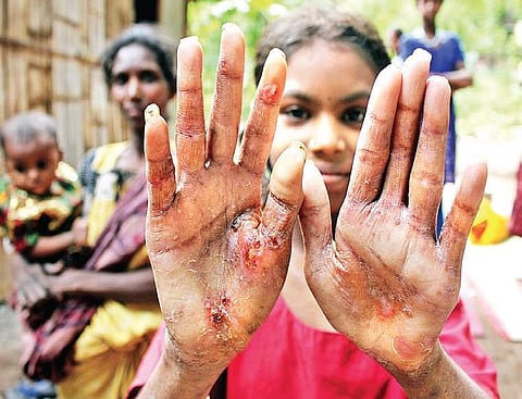 Children of Sarkarpathi display the infected sores on their body | S SENBAGAPANDIYAN