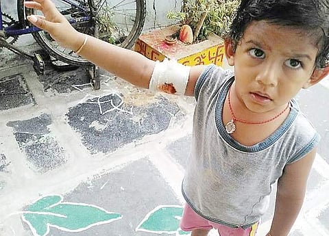 A boy showing bite marks on his right hand at Pedakurapadu in Guntur on Friday | Express