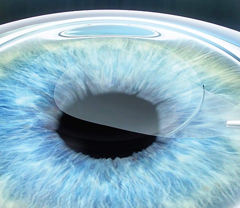 Refractive surgeries in vogue