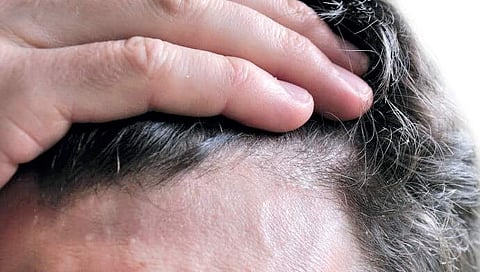 Wash your pillow covers regularly to avoid dandruff