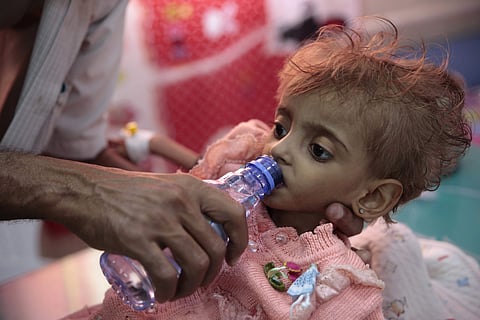 A file photo of a father gives water to his malnourished daughter at a feeding center in a hospital in Hodeida, Yemen. The United Nations children’s agency said Friday, Oct. 19, 2018 that Yemen’s economic crisis and the relentless violence at a key Red Se