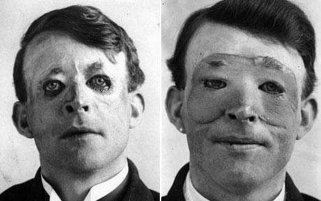 Walter Yeo, injured in the Battle of Jutland, was the first person to receive plastic surgery, before (left) and after (right) skin flap surgery performed by Sir Harold Gillies in 1917. (Photo | Wikipedia)