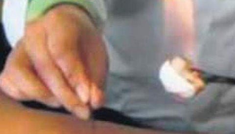 New fire needle therapy effective against scrofula