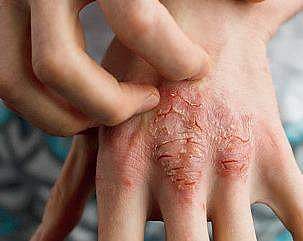 Low humidity plays a bigger role than reduced sunlight in aggravating psoriasis.