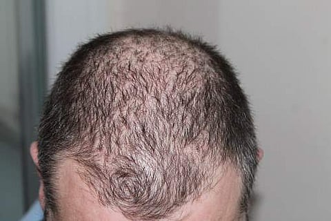Is sudden weight loss causing hair loss?