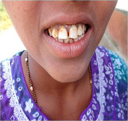 Skeletal and dental fluorosis affected people due to increasing of fluoride content in bore well water in parts of Arsikere taluk.