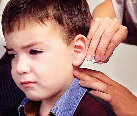 Acupuncture helps treat autism spectrum disorders