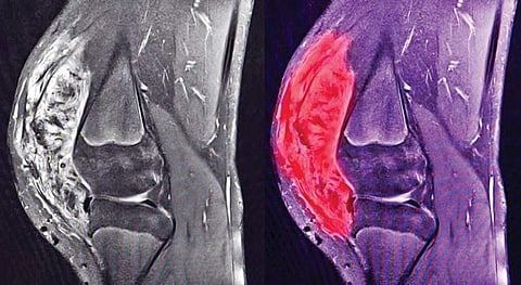 One per cent of all cancers are sarcomas
