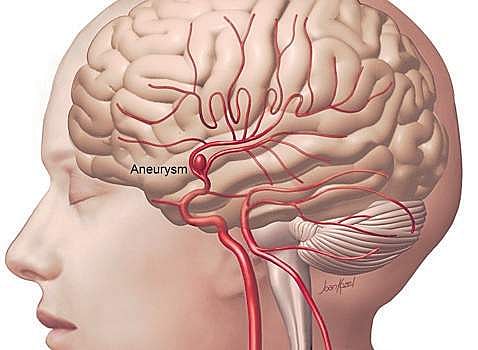 Beware of this brain blast!