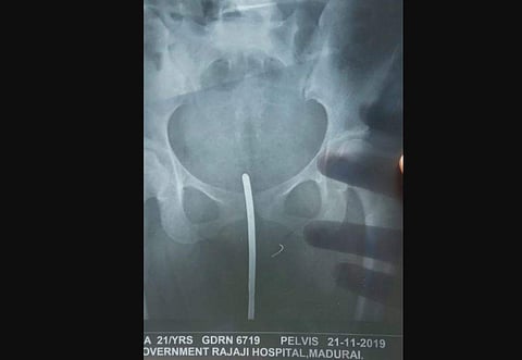 Sources at the Madurai hospital said Ramya was brought there at around 12.30 am on Thursday with the broken piece of needle intact in her pelvic bone. (Photo | EPS)