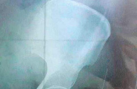 X-ray showing the needle body | EXPRESS