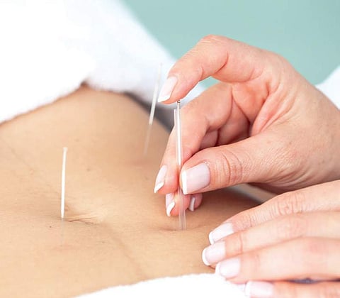 Acupuncture relieves abdominal distention