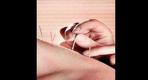 Centre set to recognise acupuncture as system of medicine