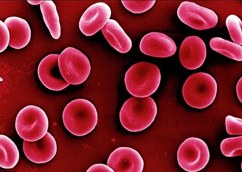 Pandemic: Anaemia on the rise among Telangana women