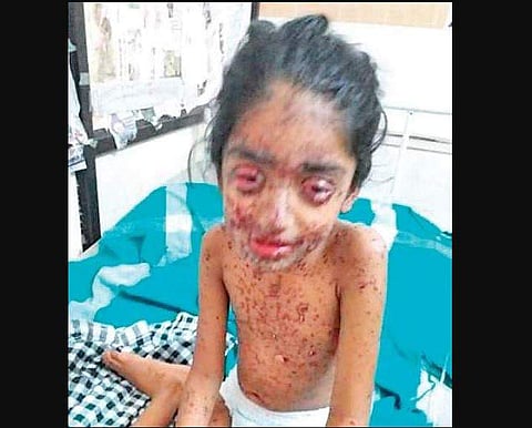 Sona, when the skin rashes appeared