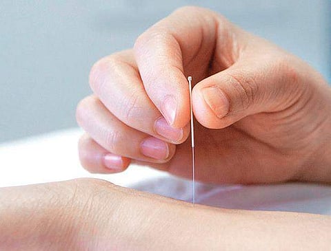 Acupuncture Can Help Treat Male Infertility