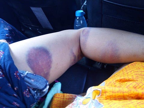 Bruise marks on one of the victims of alleged police brutality (Photo | EPS)
