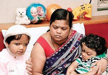 Separated conjoined twins Jaga-Balia