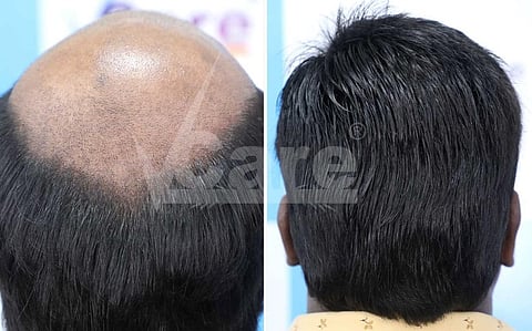 VCare's hair transplantation - A new hope for hair regrowth