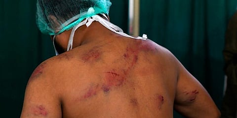 A man injured during riots receives treatment at Al-Hind hospital in old Mustafabad area. (Photo | AP)