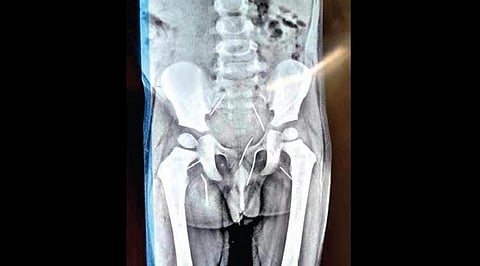 X-ray of a three-year-old boy’s body in which as many as 11 needles were found on Tuesday.
