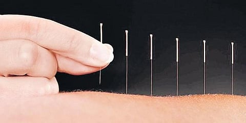 Acupuncture