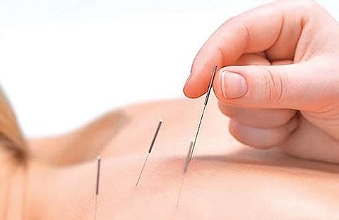 Representational image of acupuncture therapy