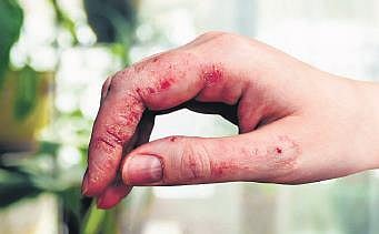 Caring for your hands​