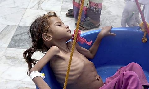 A severely malnourished seven-year-old is weighed at the Aslam Health Center in Hajjah, Yemen (File photo | AP)