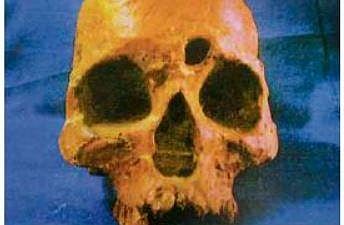 A skull showing Pott Puffy’s tumour, over the forehead | Express