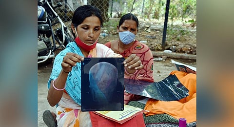 A patient infected with mucormycosis waits to be admitted at ENT Hospital in Hyderabad. (Photo | PTI)