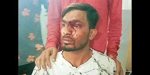 Ashraf have suffered severe injuries to his left eye (Photo | Express)