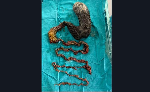  Of the 150 cm of hair, 30 cms was in the stomach and 120 cm in the small bowel. (Photo | EPS)