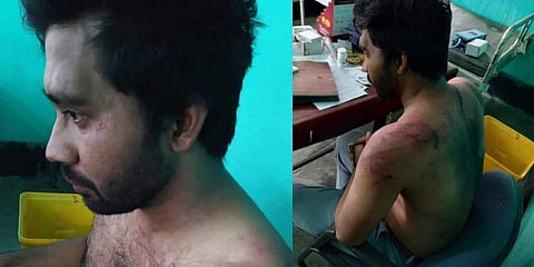 Dr Seuj Kumar Senapati shows his bruises and wounds after he was beaten by a group of people related to a patient who succumbed to Covid in Hojai district of Assam. (Photos | Express)