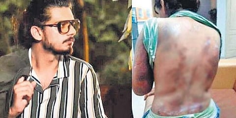 Accused Martin Joseph. The bruises on the survivor’s body.