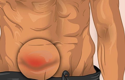How to heal hernia