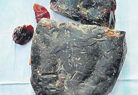 Ambergris is a waxy secretion of the sperm whale, used in the manufacture of costly pharmaceuticals and perfumes. (File Photo| Express)