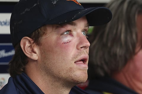 Wounded & Lost! Netherlands' Bas de Leede seen with teammates after receiving stitches in a cut after he was hit while batting during the T20 World Cup cricket match against Pakistan. (Photo AP / PTI)