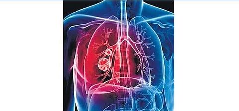 Prevalence of lung cancer among non-smokers, women rising: Study