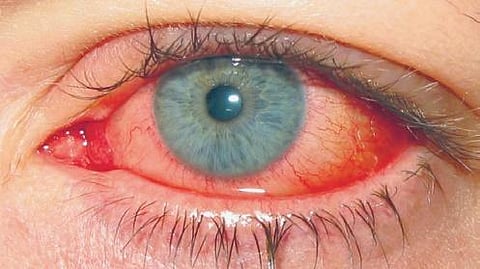 Keep an eye out for 'Madras Eye'