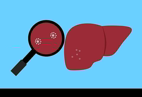 New metabolite that can detect liver cancer by urine test discovered