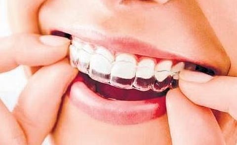 Smiles without braces