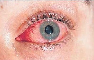 ‘Madras eye is a seasonal infection affecting the front portion of the eyeball’